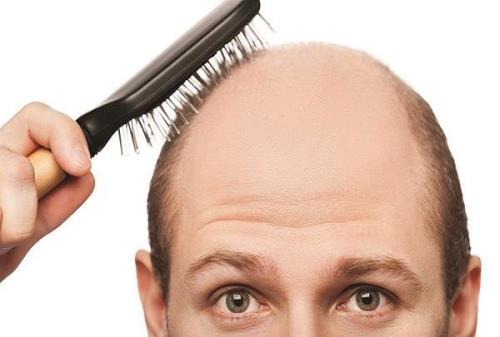 تفاوت های ریزش مو در زنان و مردان
