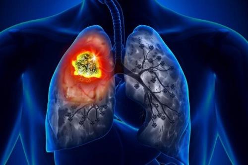 آلودگی هوا عامل مبتلا شدن به سرطان ریه در افراد غیرسیگاری