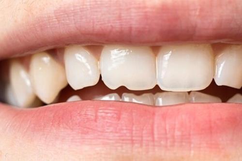 خوردن تخمه سبب فاصله افتادن بین دندان ها می شود؟