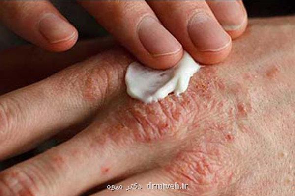 تغییر فصل، محرک اگزما نه عامل ایجاد آن