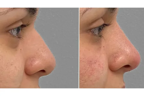 فیلر بینی و هر آنچه پیش از تزریق باید بدانید