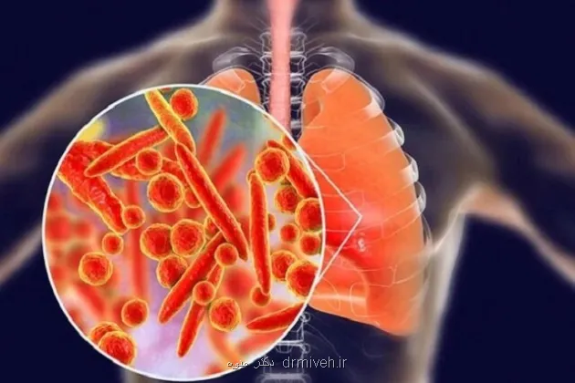 پنومونی بازهم بزرگ ترین قاتل عفونی جهان