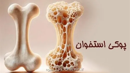 پوکی استخوان در کودکان، واقعیتی فراموش شده