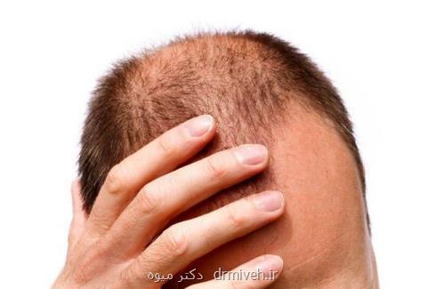 چرا موهایم می ریزد؟