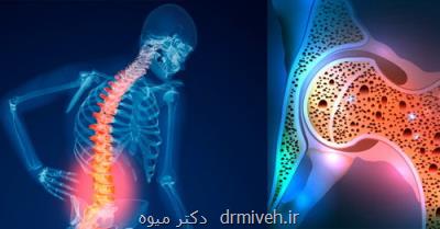 افراد بالای ۵۰ سال بیماری پوكی استخوان را جدی بگیرند