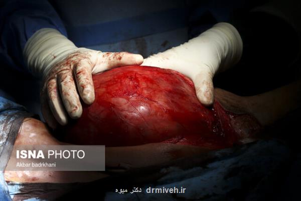برداشتن توده 9 كیلویی از بدن بیمار 78 ساله در بیمارستان شهید بهشتی یاسوج
